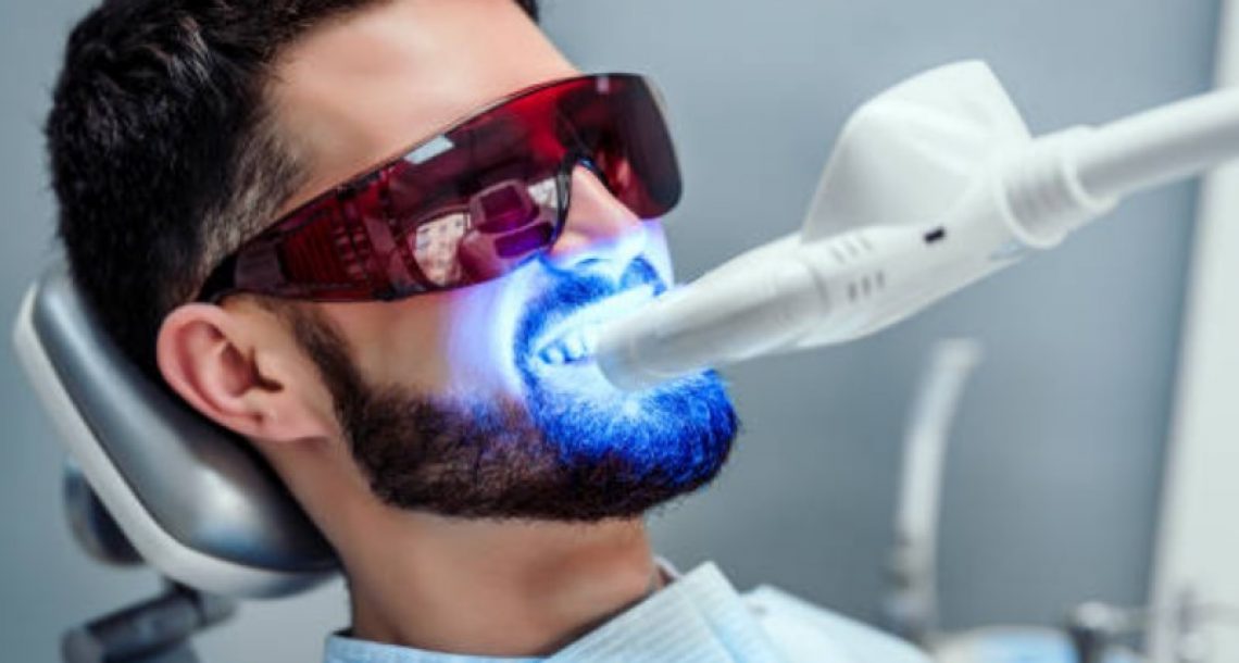 Die Ergebnisse von proffesionellen Zahnaufhellungsprodukte beim Zahnarzt sind weitaus besser