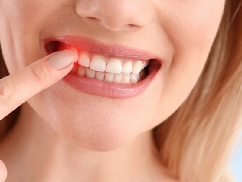 Parodontalerkrankungen sind Erkrankungen des Gewebes und der Knochen im Gebiss