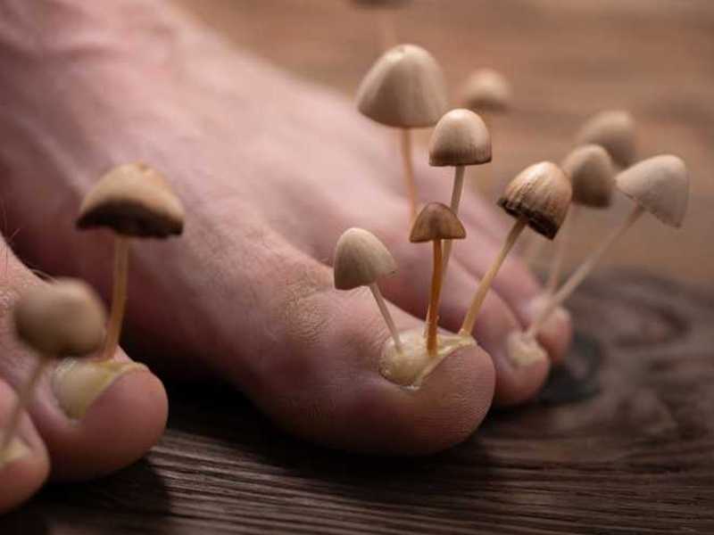 Fußpilz